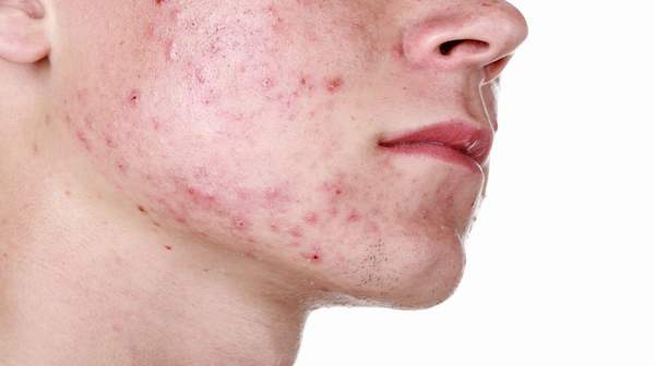 Picture of severe acne