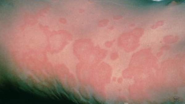 Foods Causing Eczema………..Which Foods Cause Eczema