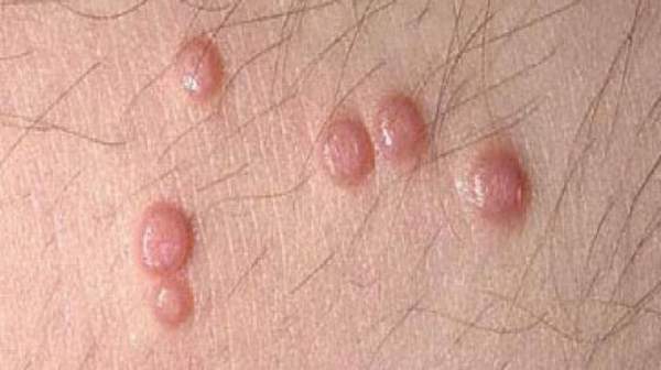 Picture of Bumps Near Vaginal Opening