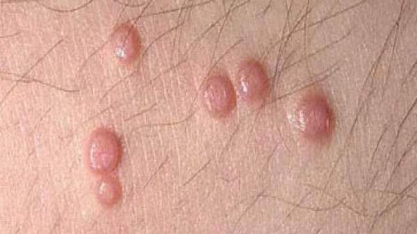 Bumps Under Skin On Vagina 16