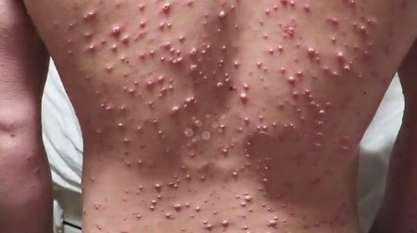 Picture of Chickenpox