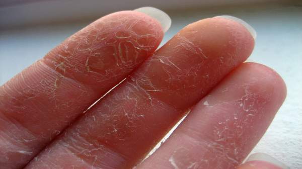 Peeling skin on palms - RightDiagnosis.com