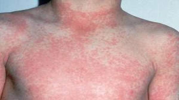 Strep Throat Rash Pictures 116