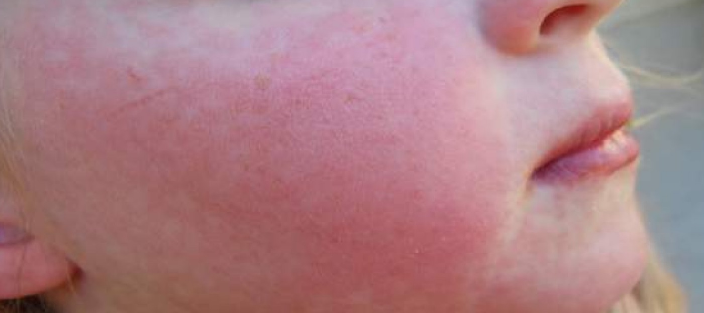 Picture of Strep Rash