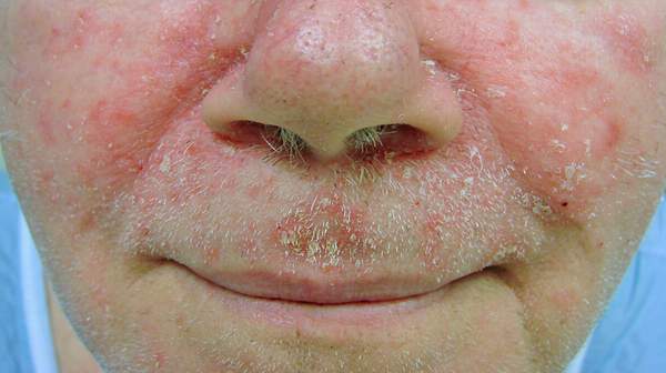 picture of Seborrheic Dermatitis