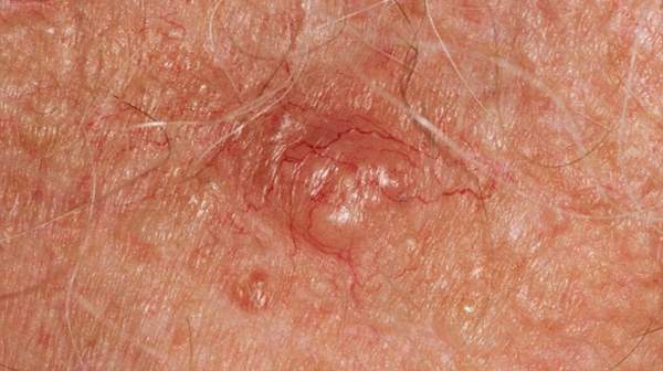 picture of skin cancer