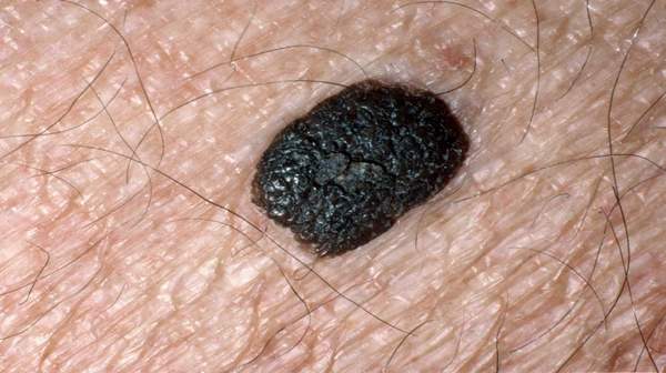 Brown Spots on the Legs of a Diabetic | LIVESTRONG.COM