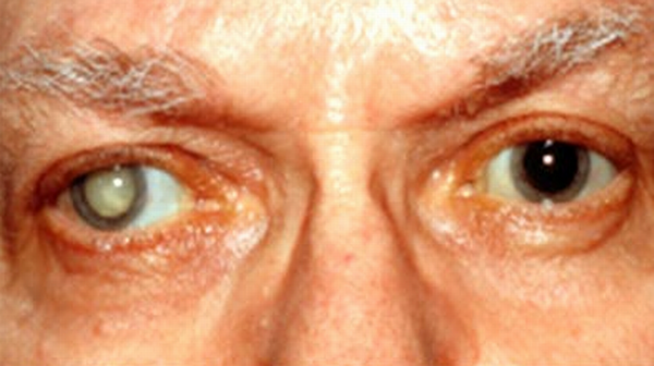 Picture of Cataracts -Symptoms, Causes, Tests