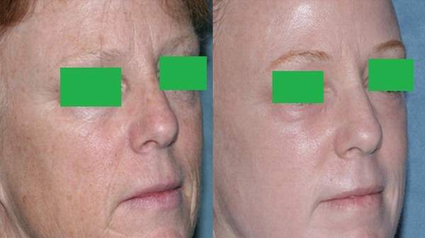 Picture of Laser resurfacing