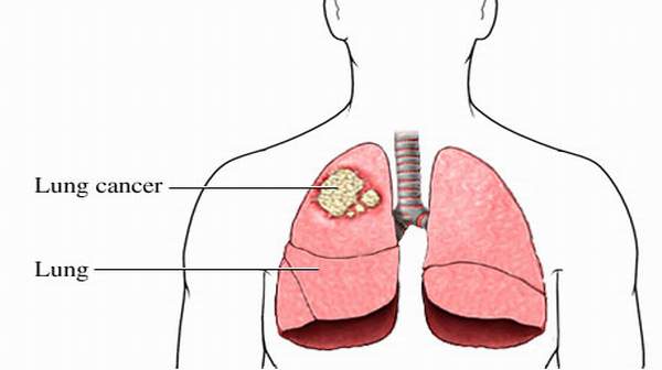 Picture of Lung Cancer