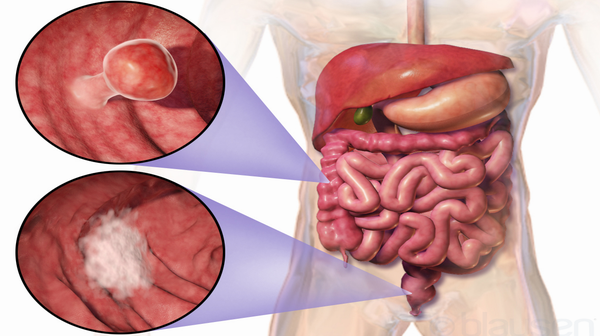 Location and appearance of two example colorectal tumors
