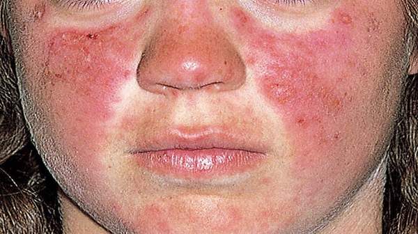 Lupus Rash