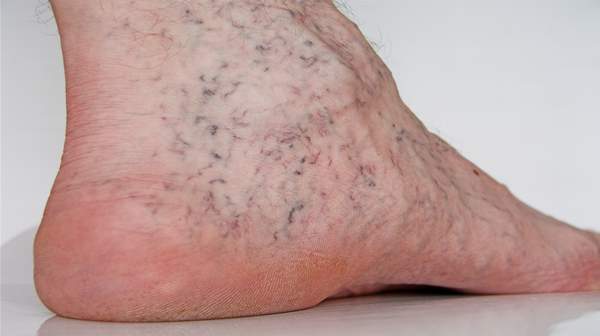 Spider Veins: Reasons behind the Blue and Purple Lines