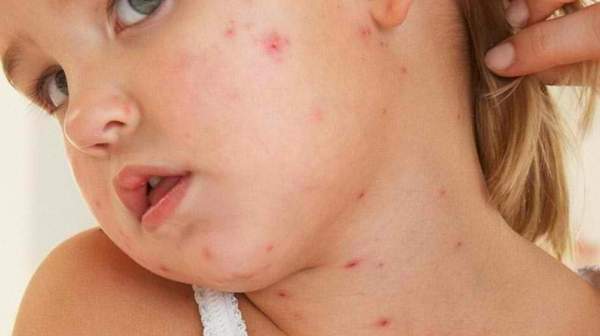 Strep Rash or Viral Scarlatina Rash - Healthy Skin Care