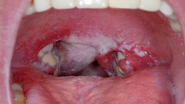 Rash In Throat 67