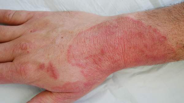 Pictures of Fungal Infections