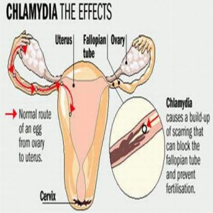 Chlamydia Infection