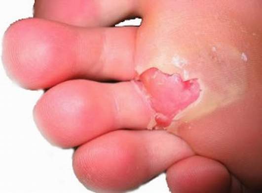 Blister