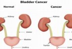 Bladder Cancer