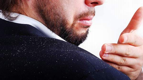 How to Get Rid of and Prevent Dandruff