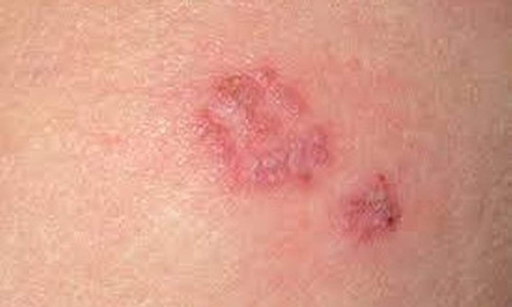 Shingles (Herpes Zoster Virus) Pictures ... - OnHealth