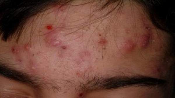 Nodular Acne Signs, acne, pimples, blemishes, comedones, whiteheads, blackheads