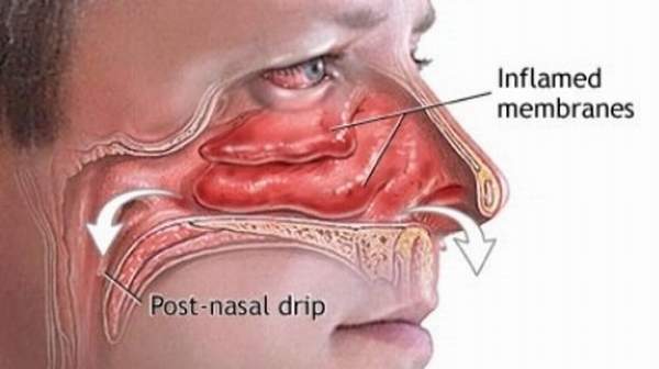 Postnasal Drip: Symptoms, Prevention and Treatments