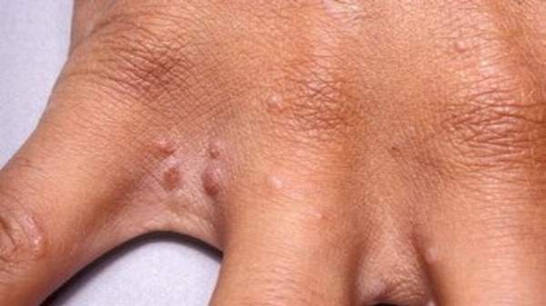 The scabies rash is often apparent on the head, face, neck,