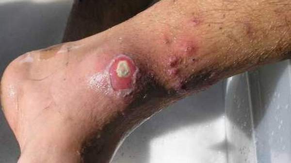 Staph Skin Infections Pictures images on Photobucket