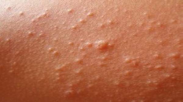 Heat Rash – Symptoms, Treatment, Pictures, Cure, Remedies