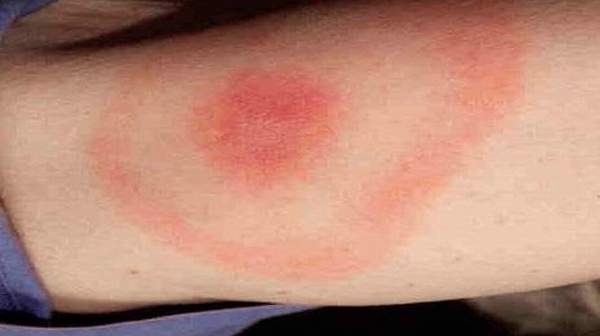 Tick Bites: Symptoms and Treatment
