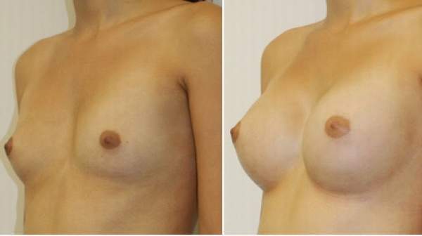 Breast Augmentation