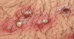 Vaginal Rash - Symptoms , Causes, Treatments