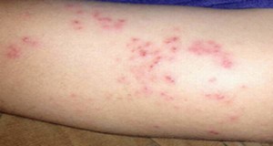 Non itchy rash can rise fever up to 103°F, NONINFECTIOUS RASHES, CAUSING THE RASH