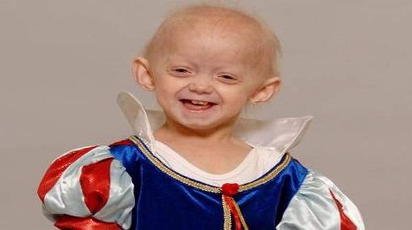 Progeria: What Causes & Other similar syndromes