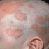 Seborrheic Eczema, Eczema, cradle cap,