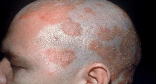Seborrheic Eczema, Eczema, cradle cap,