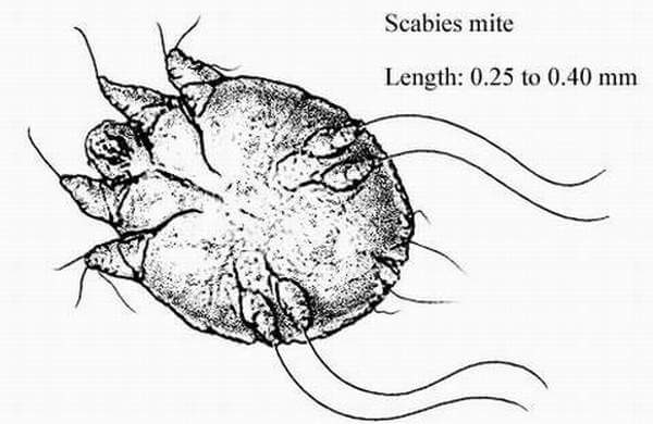 Scabies Mite, superficial burrows, intense pruritus (itching), secondary infection