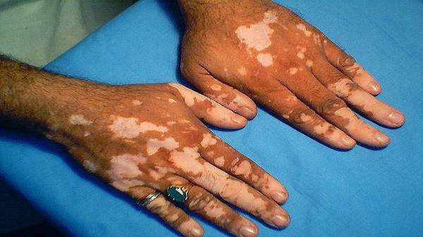 vitiligo_fingers