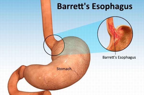 Barrett's Esophagus Symptoms and Treatments