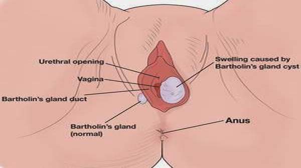 Bartholin's Cyst And How To Treat It
