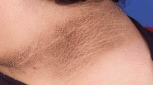 Can Acanthosis Nigricans be Prevented