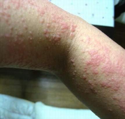 What is Cold urticaria