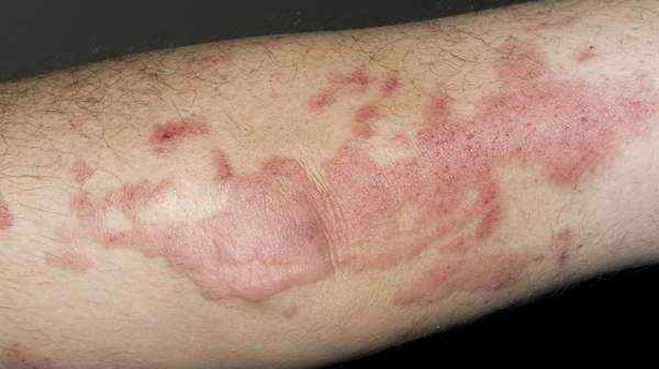 Contact Dermatitis, Symptoms of Contact dermatitis, Treatment of Contact dermatitis