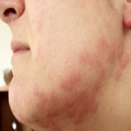 Dust mite allergy Symptoms