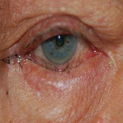 Entropion eyelid commonly affected