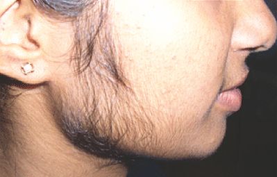 Steroid acne prevention