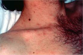 acute mild-hiv-rash