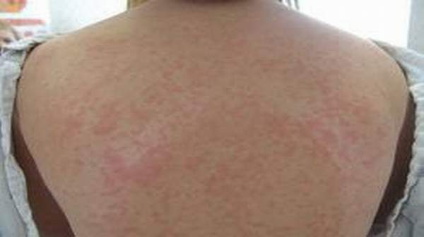 acute mild-hiv-rash