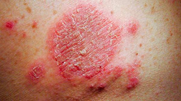 picture of discoid eczema